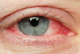 Покраснение глаз. Причины и лечение